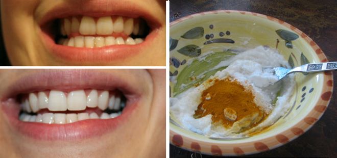 teethwhitener