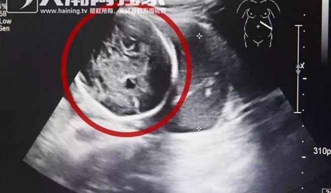 怀孕6个月照超音波 惊见「子宫却是空的」?