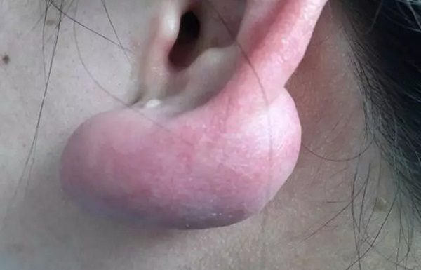 穿耳洞耳垂竟长大肉球 多次切除了又再生