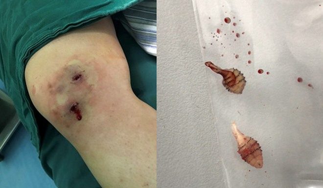 女漫步河边被虫咬一口 一个星期后小腿爬出蛆虫