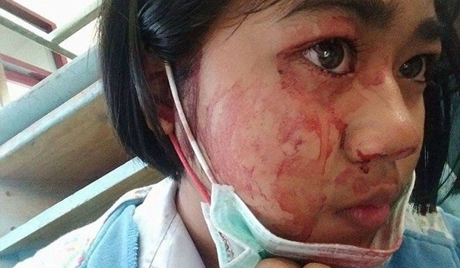 女童患离奇怪病 头一痛五官开始流血