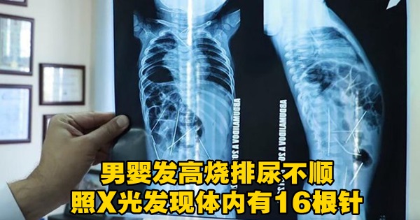 x-ray image of the needles inside the boy's body