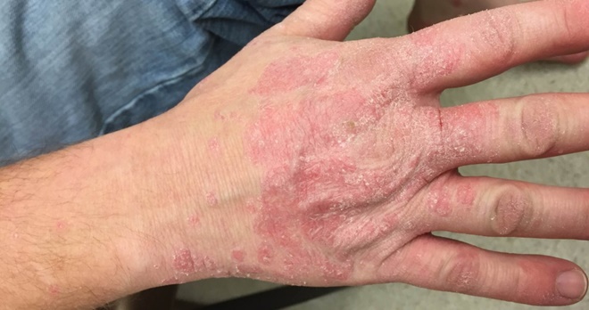 Mild-Psoriasis