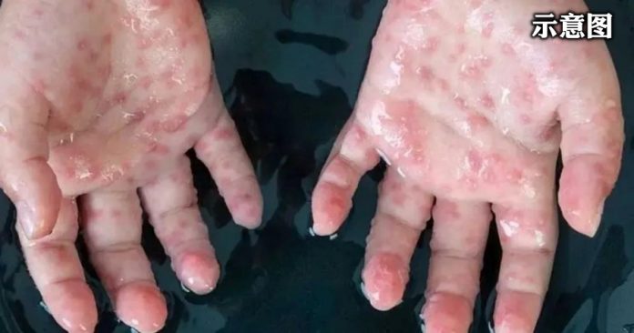 Rare-monkeypox-outbreak-1068x561