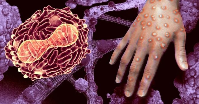 MonkeyPox-by-sexual-relation