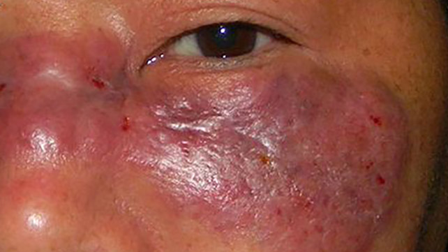 1220-Mucormycosis-642x361-slide2