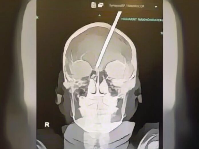 boy-shoots-harpoon-into-his-head