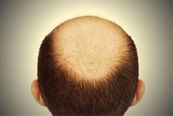 loss-123hair